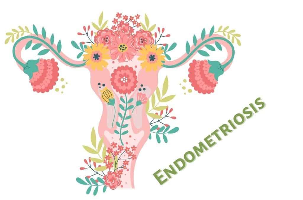 Endometriosis – Causa y manejo nutricional